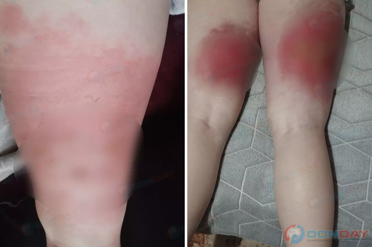 В Ростовской области молодая мама получила страшные ожоги из-за лопнувшего крана