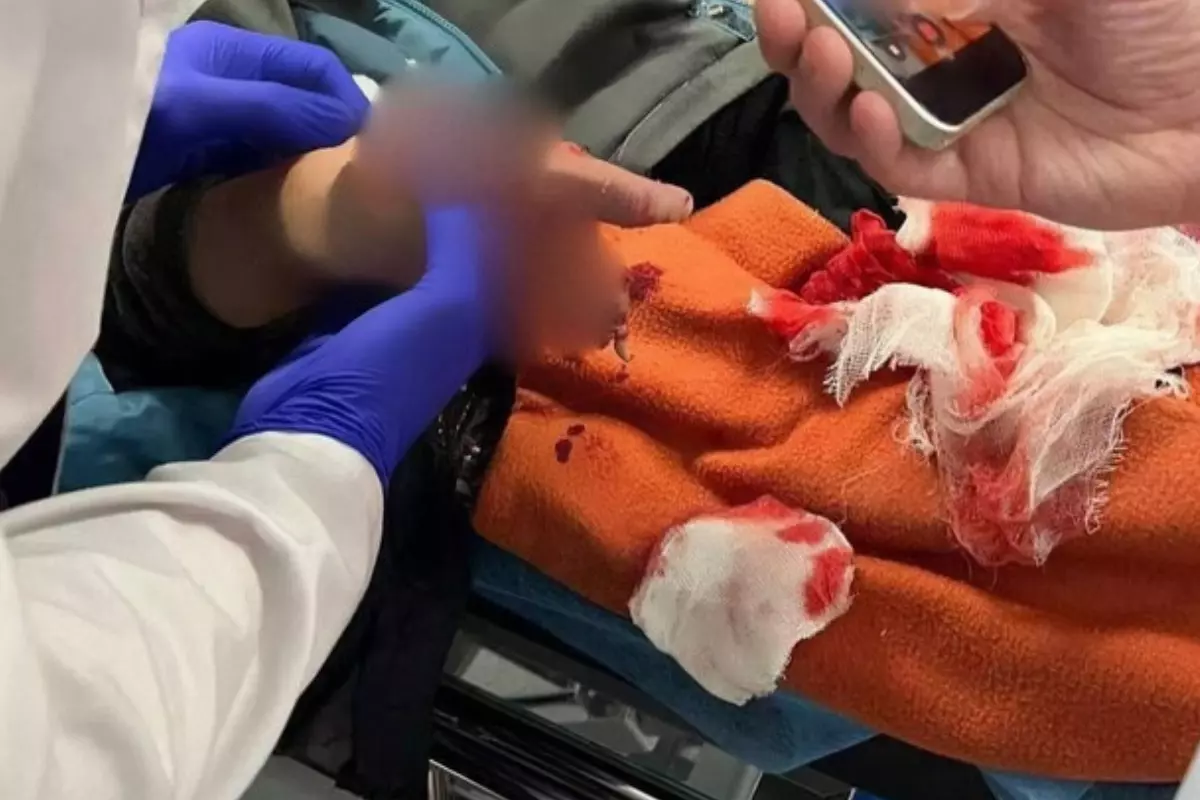 В Красногорске пострадал 9-летнему мальчику оторвало пальцы из-за мины в купюре