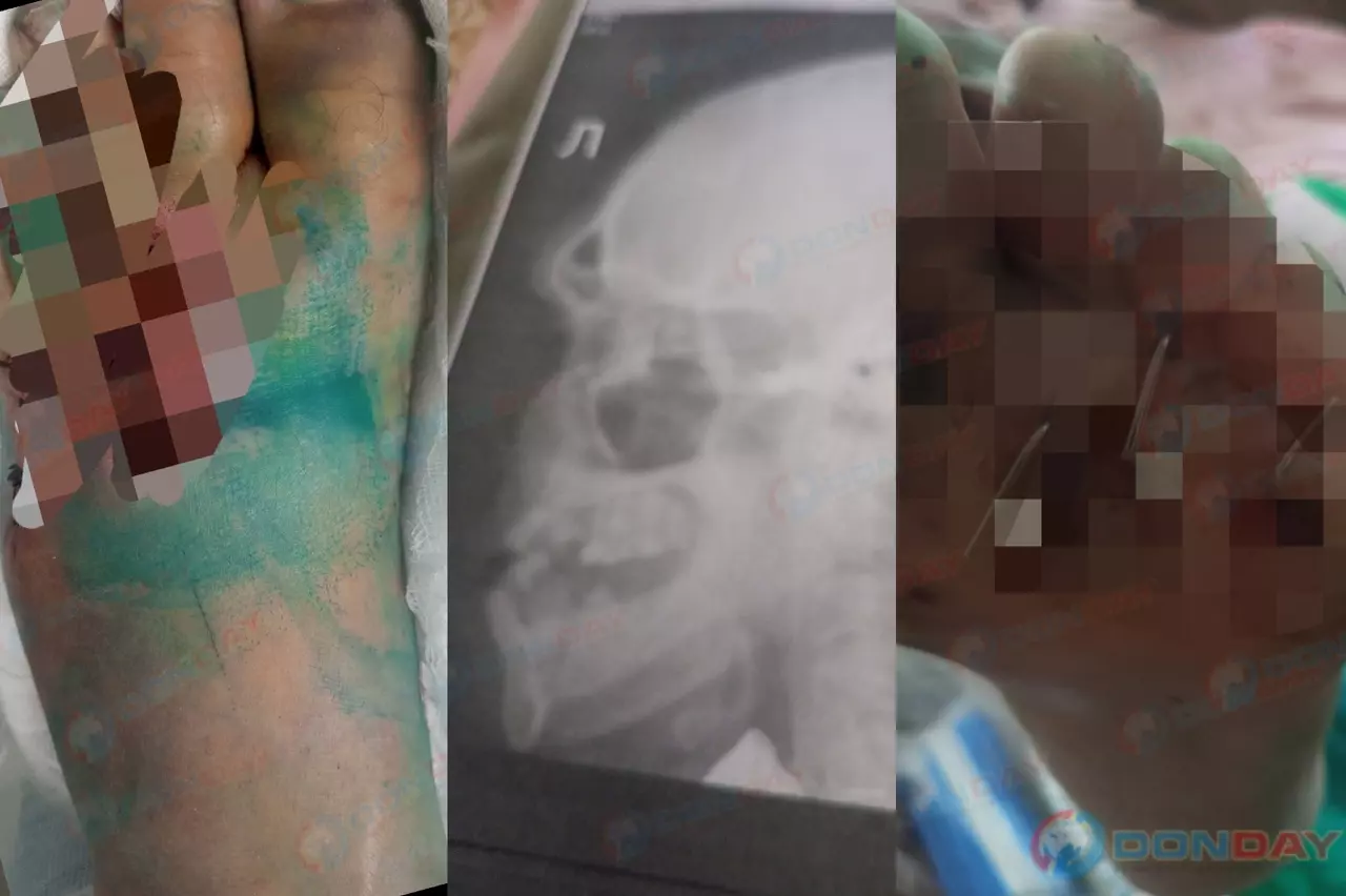 Записи с камер исчезли: дело жестоко избитого жителя Новочеркасска повисло в воздухе