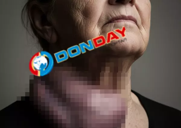 Фото к материалу: В Ростове хирурги удалили пациентке щитовидку в 55 раз больше нормы