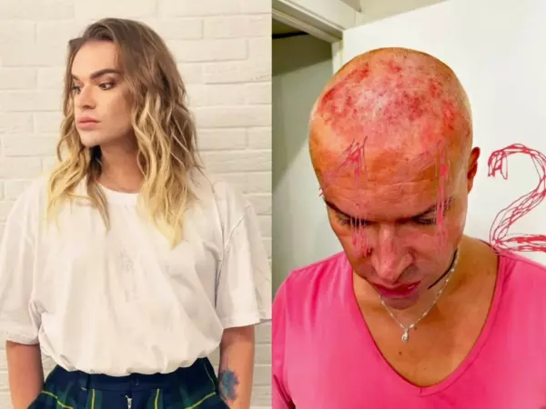Фото к материалу: Жуткие ожоги по всей голове: Гогену Солнцеву в салоне сожгли кожу